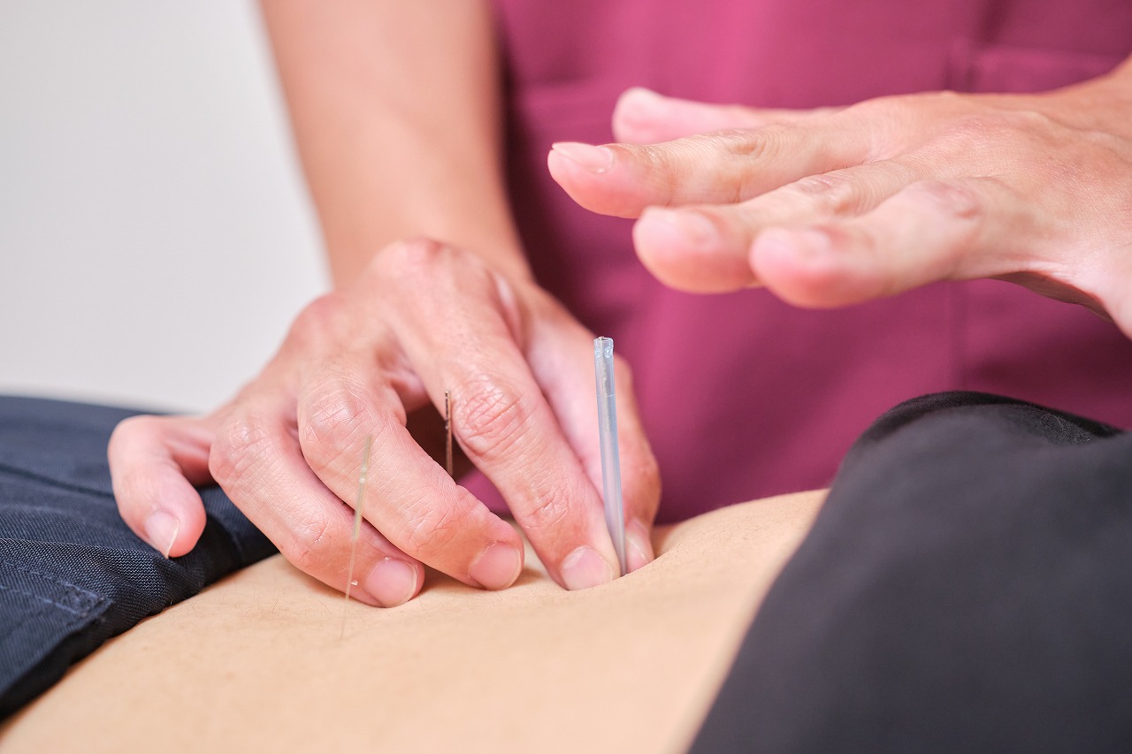はり施術